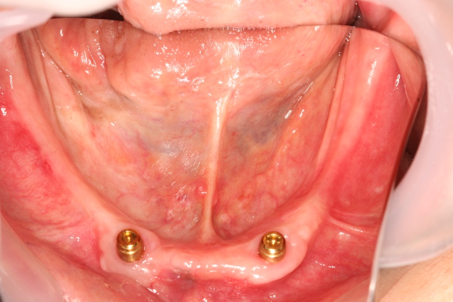インプラント義歯2