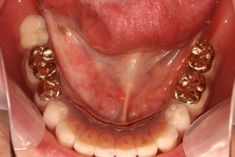インプラント義歯2
