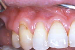 59歳女性の上顎前歯部に生じた歯肉退縮