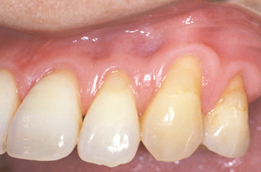 59歳女性の上顎前歯部に生じた歯肉退縮2