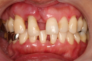 歯が自然脱落した侵襲性歯周炎の40代女性