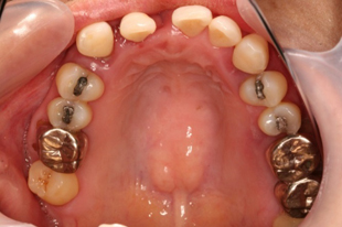 歯が自然脱落した侵襲性歯周炎の40代女性