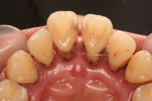 歯石が沈着している中程度に進行している歯周病罹患者の口腔内