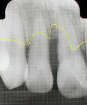 歯周組織再生療法１
